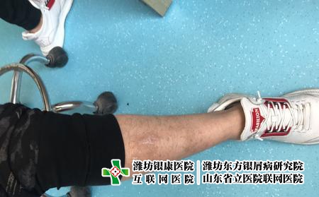 牛皮癬用藥該如何選擇,牛皮癬怎么用藥治 牛皮癬用藥該如何選擇,牛皮癬怎么用藥治