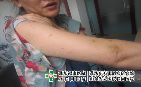 兒童得了牛皮癬怎么辦,小孩有牛皮癬怎么治好 兒童得了牛皮癬怎么辦,小孩有牛皮癬怎么治好