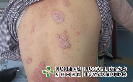 牛皮癬早期的發(fā)病癥狀有哪些，牛皮癬剛開始什么樣