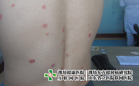 牛皮癬發(fā)病原因有哪些，為什么牛皮癬會(huì)反復(fù)