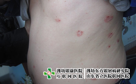 牛皮癬患者能不能用激素藥，牛皮癬能用激素治療嗎