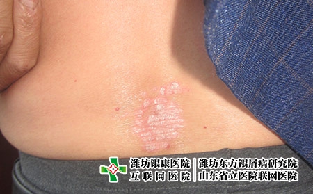 用藥期間牛皮癬關(guān)節(jié)炎患者要注意什么，牛皮癬怎么用藥