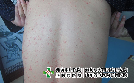 診斷早期牛皮癬的癥狀是什么，牛皮癬是怎么出現的