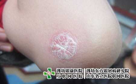 預防牛皮癬復發(fā)的原則,怎么避免牛皮癬的反復 預防牛皮癬復發(fā)的原則,怎么避免牛皮癬的反復