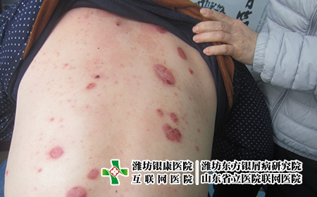 濰坊治療牛皮癬費(fèi)用要多少,怎么治牛皮癬省錢 濰坊治療牛皮癬費(fèi)用要多少,怎么治牛皮癬省錢