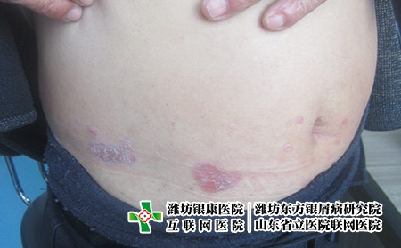 濰坊牛皮癬哪個(gè)醫(yī)院好，哪里的醫(yī)院可以治好牛皮癬