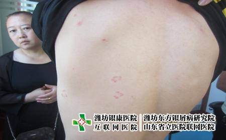 在濰坊醫(yī)治牛皮癬要花多少錢，為什么濰坊東方不貴