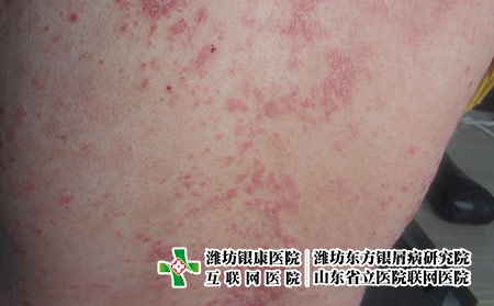 牛皮癬患者的飲食有什么講究,牛皮癬不能吃什么 牛皮癬患者的飲食有什么講究,牛皮癬不能吃什么