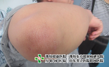 牛皮癬的護(hù)理方法都有哪些，怎么幫助牛皮癬護(hù)理