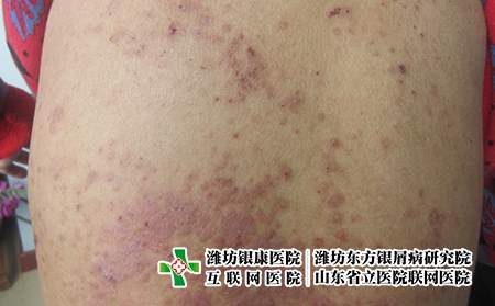 兒童牛皮癬如何防治，小孩有牛皮癬怎么辦