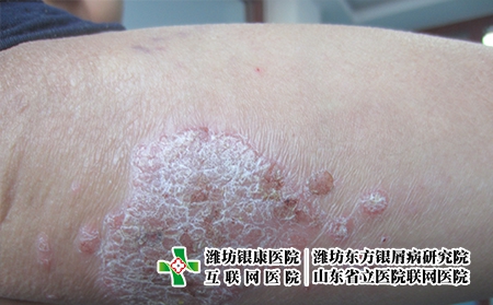 牛皮癬治療不當的危害有哪些，牛皮癬老不好怎么辦