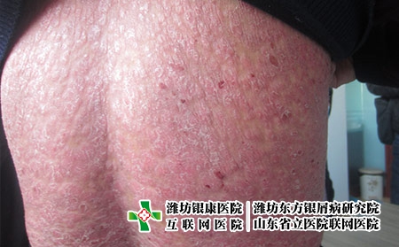 怎樣才能擺脫牛皮癬的糾纏，牛皮癬好了怎么預防反復