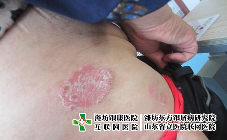 牛皮癬早期的表現特征什么樣，牛皮癬怎么診斷