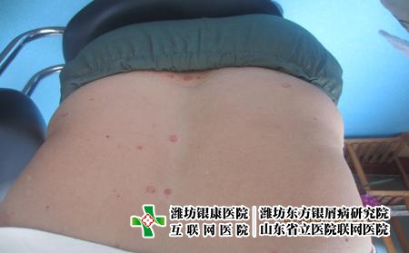 中藥治療牛皮癬關節炎的方法有哪些,中醫怎么治牛皮癬 中藥治療牛皮癬關節炎的方法有哪些,中醫怎么治牛皮癬