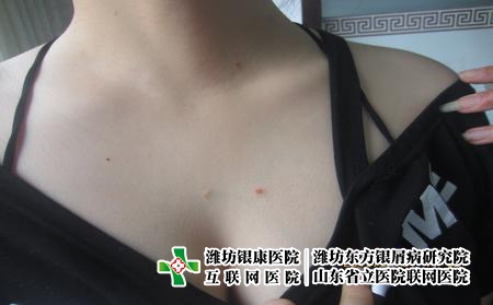 牛皮癬有什么預(yù)防的措施，牛皮癬如何減少發(fā)作