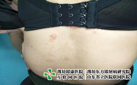 女性牛皮癬怎么調(diào)整護理，女性得了牛皮癬怎么辦