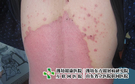 什么是牛皮癬？得了牛皮癬怎么辦