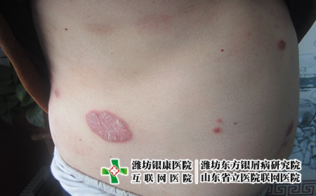 牛皮癬為什么會癢，牛皮癬會發癢嗎