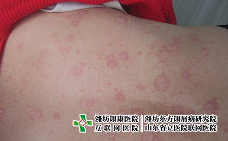 牛皮癬的治療效果和什么有關(guān)，什么會影響牛皮癬的治療