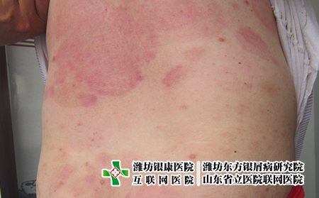 牛皮癬疾病的癥狀有哪些，什么樣的皮膚病是牛皮癬