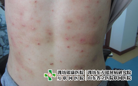 為什么治療牛皮癬無效果，什么會導致牛皮癬越治越重