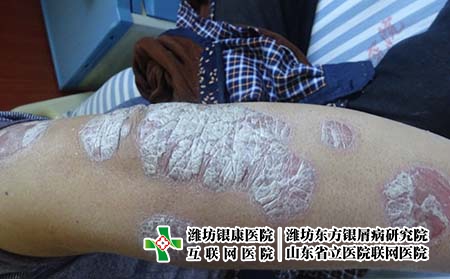 預防牛皮癬的要點是什么，牛皮癬好了之后要怎么做