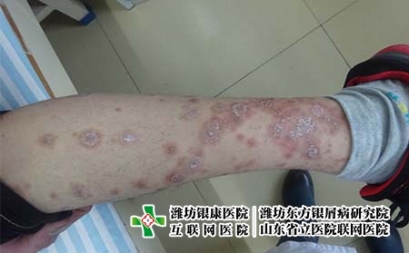 牛皮癬患者吸煙會(huì)怎么樣，得了牛皮癬能吸煙嗎