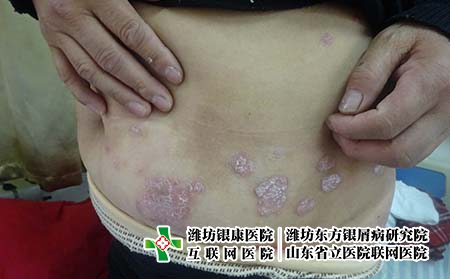 女性牛皮癬難治療的原因，牛皮癬治不好因為什么