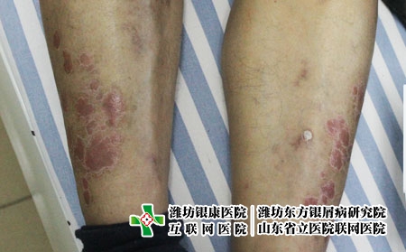 有效治療牛皮癬如何做到，治療牛皮癬時怎么護理