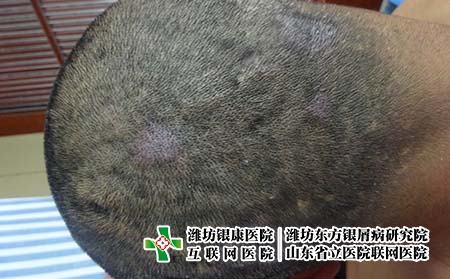 牛皮癬患者的洗頭要注意的事項,頭部牛皮癬如何護(hù)理 牛皮癬患者的洗頭要注意的事項,頭部牛皮癬如何護(hù)理