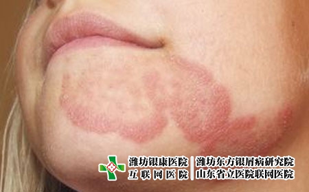 牛皮癬患者怎么選擇化妝品，得了牛皮癬能用化妝品嗎