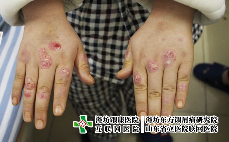 牛皮癬究竟會不會傳染，牛皮癬會不會傳染給家人