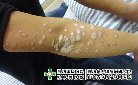 牛皮癬的中藥調理方法，牛皮癬怎么用中醫治療