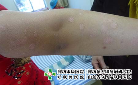 牛皮癬應(yīng)該去什么醫(yī)院治療，濰坊哪家醫(yī)院治牛皮癬好一點(diǎn)