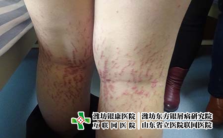 濰坊治療牛皮癬的醫院怎么選，濰坊銀屑病東方杰出