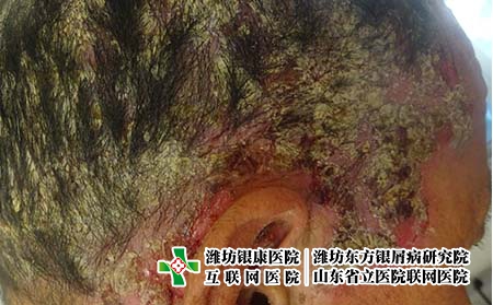 頭皮型牛皮癬該怎么治療好，頭部長銀屑病怎么辦