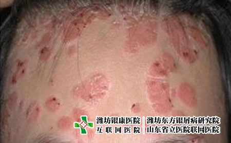牛皮癬的初期癥狀有哪些，銀屑病剛開(kāi)始怎么判斷