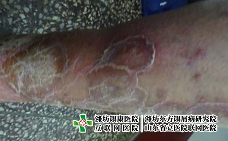 通過運動治療牛皮癬要注意什么，運動對銀屑病有幫助嗎