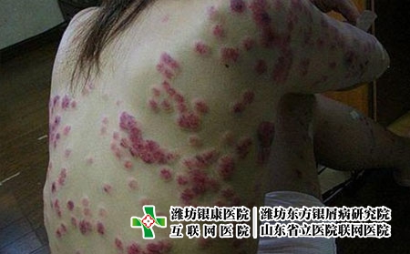 年輕牛皮癬患者藥物治療注意事項，有銀屑病要怎么用藥