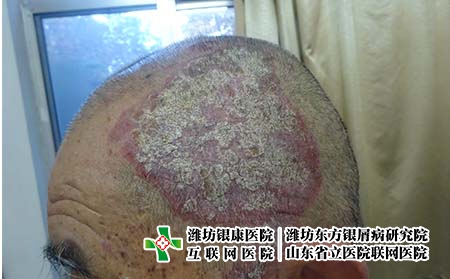 濰坊好的牛皮癬醫院怎么找，濰坊東方銀屑病醫院好嗎