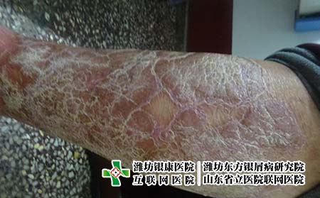 牛皮癬常見的發(fā)病原因，什么容易導(dǎo)致銀屑病發(fā)作