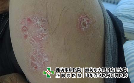 牛皮癬到底是因為什么而導致反復，銀屑病復發是因為什么