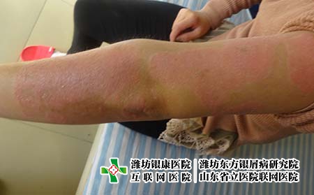 得了牛皮癬該怎么辦,銀屑病治療不好怎么辦 得了牛皮癬該怎么辦,銀屑病治療不好怎么辦