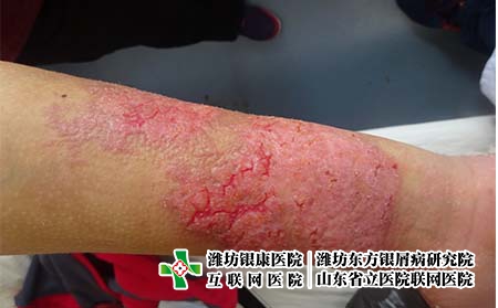 臉部牛皮癬的保護和調節怎樣好，臉上長銀屑病要怎么護理