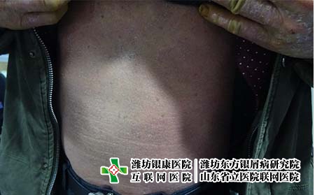 醫院治療牛皮癬的費用是多少，濰坊東方治銀屑病專業