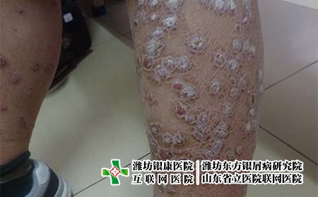 濰坊那里治牛皮癬好，專治牛皮癬的醫院在哪