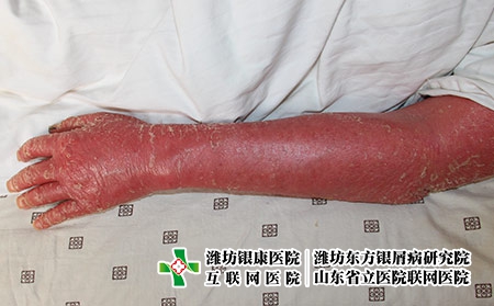 紅皮型牛皮癬的危害，銀屑病會(huì)引起什么后果