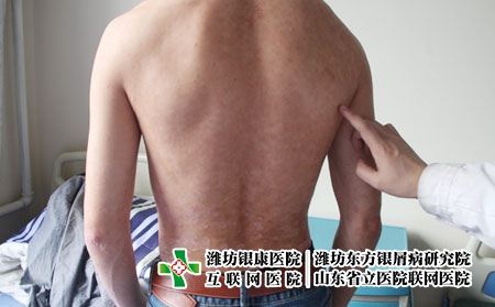 預防牛皮癬的各種有效措施,有銀屑病怎么預防發作 預防牛皮癬的各種有效措施,有銀屑病怎么預防發作