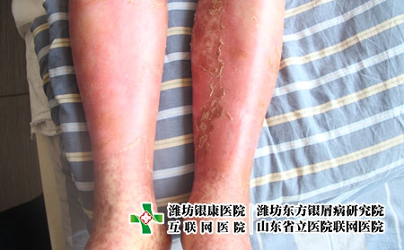 牛皮癬患者吃什么健康,銀屑病有什么忌口 牛皮癬患者吃什么健康,銀屑病有什么忌口