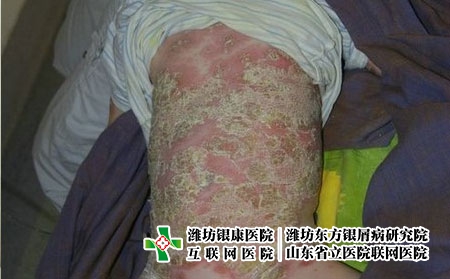 手部牛皮癬的護理措施有哪些，四肢銀屑病要注意什么